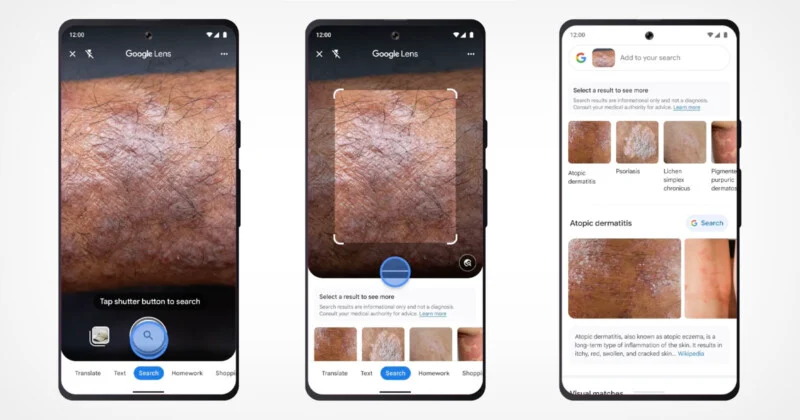 Google Lens now identify the skin conditions from images captured